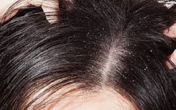 খুশকির সমস্যা সমাধান করুন ৩ উপাদানে